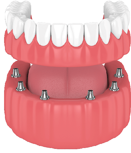 Dental Full Bridge
