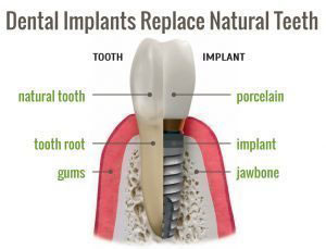 Dental Implants Replace with Natural Teeth