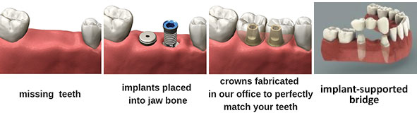 Multiple Implants and Implant-Supported Bridges