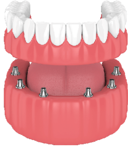 Dental Full Bridge